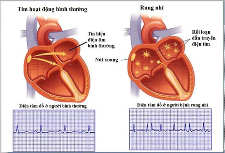 So sánh tim rung nhĩ và không rung nhĩ - Máy đo huyết áp bắp tay Microlife B3 Afib Advance
